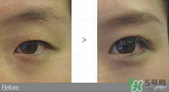 埋線雙眼皮需要拆線嗎？埋線雙眼皮怎么拆線