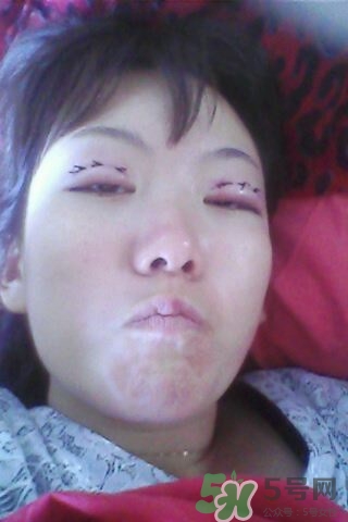 什么是定點(diǎn)雙眼皮？定點(diǎn)雙眼皮多少錢(qián)？