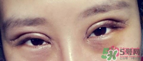 切開雙眼皮多久消腫？切開雙眼皮多久恢復(fù)？