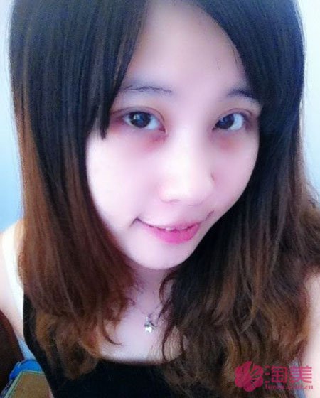 三點雙眼皮恢復過程圖_韓式三點雙眼皮多久恢復自然