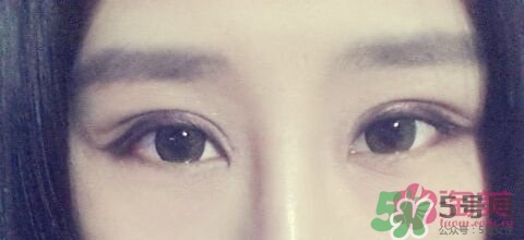 切開雙眼皮多久消腫？切開雙眼皮多久恢復(fù)？