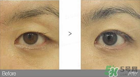 埋線雙眼皮需要拆線嗎？埋線雙眼皮怎么拆線