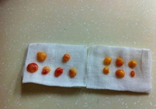 韓式三點(diǎn)雙眼皮是永久嗎？三點(diǎn)雙眼皮能保持多久？