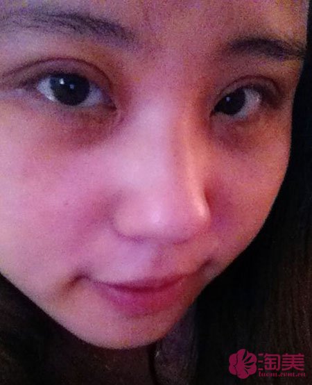 三點雙眼皮恢復過程圖_韓式三點雙眼皮多久恢復自然