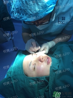 定點雙眼皮恢復過程圖_定點雙眼皮要多久恢復 定點雙眼皮恢復過程圖_定點雙眼皮要多久恢復