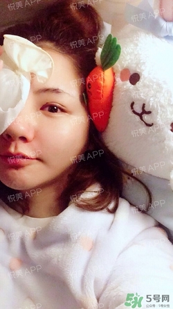 定點雙眼皮恢復過程圖_定點雙眼皮要多久恢復 定點雙眼皮恢復過程圖_定點雙眼皮要多久恢復