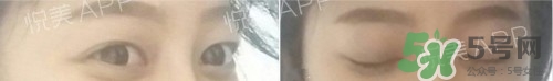 埋線雙眼皮多久恢復(fù)自然？埋線雙眼皮多久能恢復(fù)