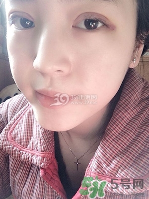 什么是定點(diǎn)雙眼皮？定點(diǎn)雙眼皮多少錢(qián)？