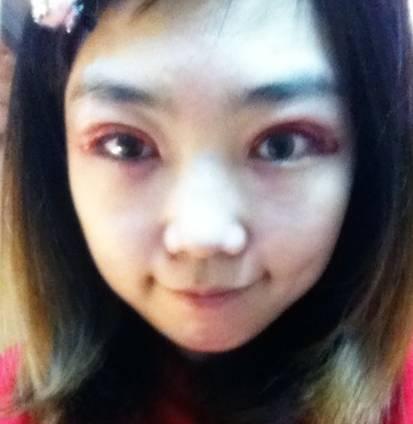 韓式三點(diǎn)雙眼皮是永久嗎？三點(diǎn)雙眼皮能保持多久？