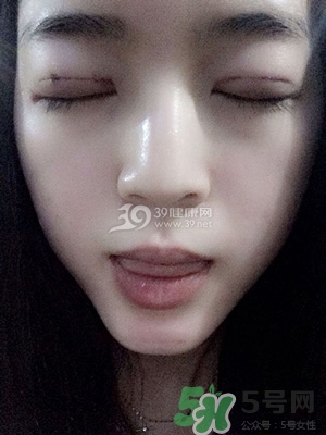 什么是定點(diǎn)雙眼皮？定點(diǎn)雙眼皮多少錢(qián)？