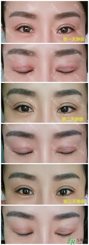 埋線雙眼皮能保持多久？埋線雙眼皮是永久嗎