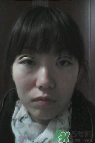 什么是定點(diǎn)雙眼皮？定點(diǎn)雙眼皮多少錢(qián)？