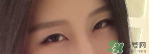 切開雙眼皮多久消腫？切開雙眼皮多久恢復(fù)？