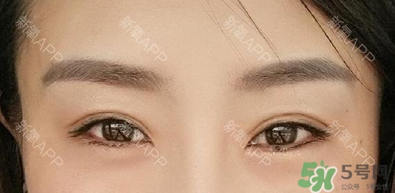 埋線雙眼皮能保持多久？埋線雙眼皮是永久嗎