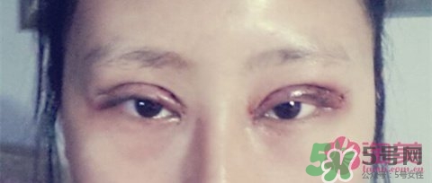 切開雙眼皮多久消腫？切開雙眼皮多久恢復(fù)？