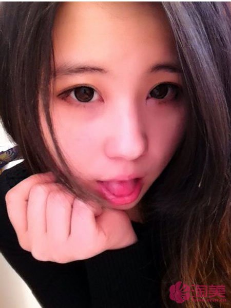 三點雙眼皮恢復過程圖_韓式三點雙眼皮多久恢復自然