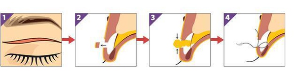 定點雙眼皮怎么做？定點雙眼皮需要拆線嗎？