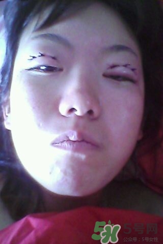 什么是定點(diǎn)雙眼皮？定點(diǎn)雙眼皮多少錢(qián)？