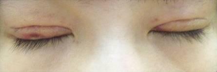 韓式三點(diǎn)雙眼皮是永久嗎？三點(diǎn)雙眼皮能保持多久？