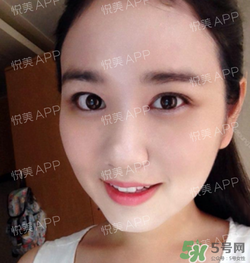 埋線雙眼皮的危害_埋線雙眼皮有風(fēng)險后遺癥嗎 埋線雙眼皮的危害_埋線雙眼皮有風(fēng)險后遺癥嗎