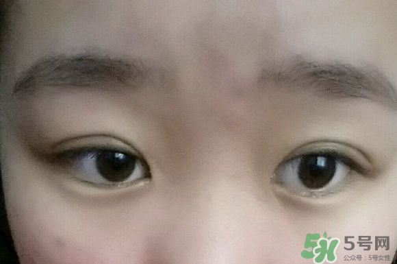 埋線雙眼皮需要拆線嗎？埋線雙眼皮怎么拆線