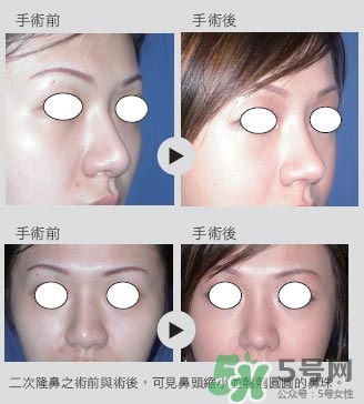 二次隆鼻注意事項(xiàng)_第二次隆鼻直接做嗎 二次隆鼻注意事項(xiàng)_第二次隆鼻直接做嗎