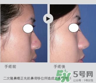 二次隆鼻注意事項(xiàng)_第二次隆鼻直接做嗎 二次隆鼻注意事項(xiàng)_第二次隆鼻直接做嗎