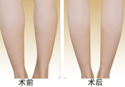 小腿吸脂多久見效？小腿吸脂后多久能看見效果？