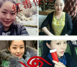 美國紅毒溶脂怎么樣？美國紅毒溶脂有用嗎？