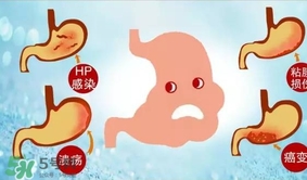 神經(jīng)性胃痙攣是什么？神經(jīng)性胃痙攣是什么原因？