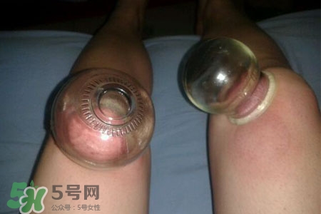 拔罐瘦腿真的有效嗎？腿部拔火罐減肥效果好嗎？