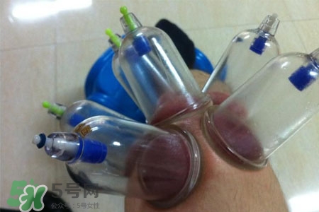 小腿能拔罐嗎？在小腿上拔火罐有什么作用？