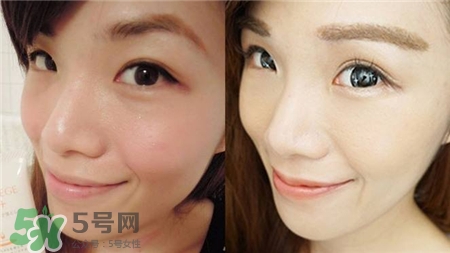 淚溝可以打玻尿酸嗎?淚溝打玻尿酸維持多久? 淚溝可以打玻尿酸嗎?淚溝打玻尿酸維持多久?