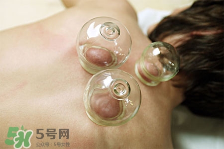 拔罐分季節(jié)嗎？不同季節(jié)的拔罐禁忌