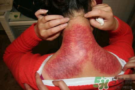 刮痧可以治頸椎病嗎？刮痧能治療頸椎病嗎？