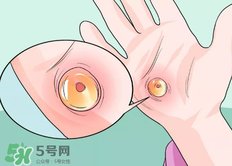 水泡怎么處理？水泡要不要刺破？