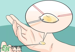 水泡怎么處理？水泡要不要刺破？