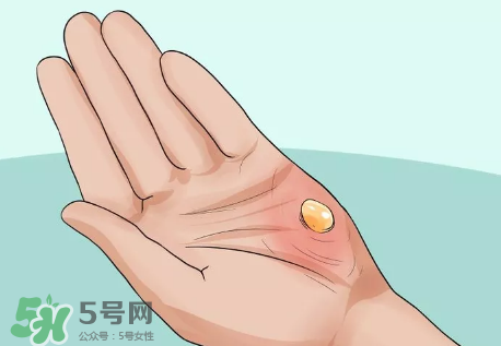 水泡怎么處理？水泡要不要刺破？