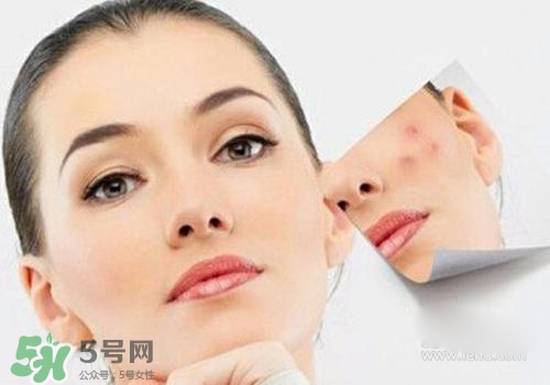 封閉性粉刺會自己消失嗎？封閉性粉刺好了會留疤嗎？