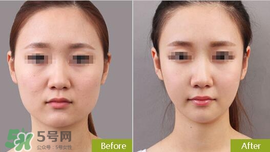 瘦臉針?lè)譃閹追N類(lèi)型？瘦臉針有哪幾個(gè)牌子？