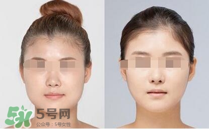 瘦臉針?lè)譃閹追N類(lèi)型？瘦臉針有哪幾個(gè)牌子？