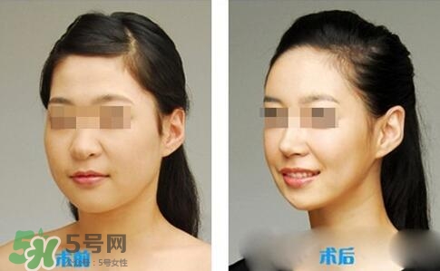 瘦臉針?lè)譃閹追N類(lèi)型？瘦臉針有哪幾個(gè)牌子？