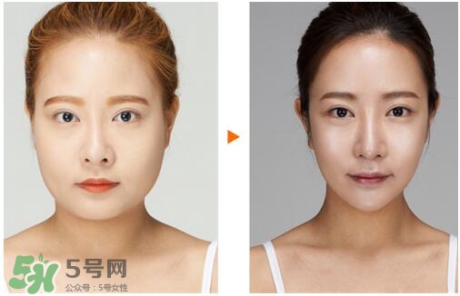 瘦臉針?lè)譃閹追N類(lèi)型？瘦臉針有哪幾個(gè)牌子？