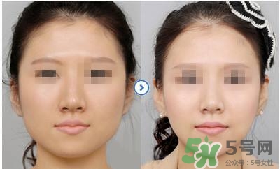 打瘦臉針疼不疼？打瘦臉針的注意事項(xiàng)