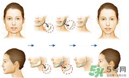 瘦臉針進(jìn)口好還是國產(chǎn)好？瘦臉針國產(chǎn)和進(jìn)口的區(qū)別