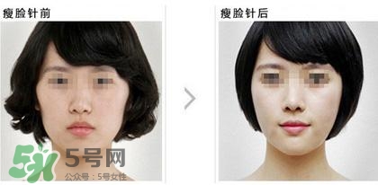 打瘦臉針能喝酒嗎？打瘦臉針能吃海鮮嗎？