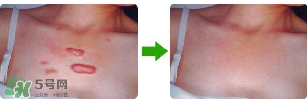 祛疤痕最好的方法有哪些？祛疤痕的簡單方法