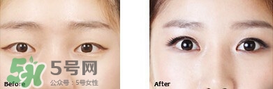 開眼角要恢復(fù)多久？開眼角好不好？