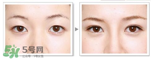 割雙眼皮有什么后遺癥嗎？割雙眼皮有什么危害性？