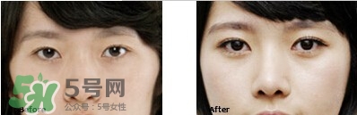 開眼角要恢復(fù)多久？開眼角好不好？